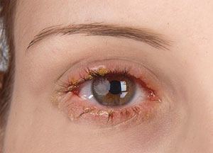 blepharitis