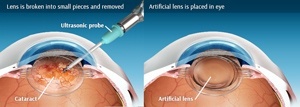 cataract-surgery