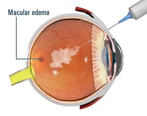 intravitreal _triamcinolone