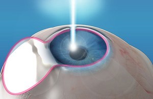 laser-refractive-surgery