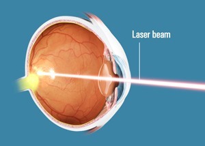 Eye laser treatment