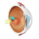 macular-degeneration