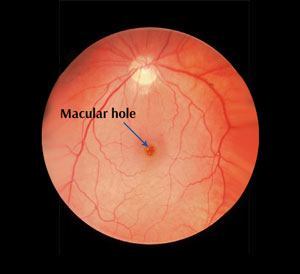 macular-hole