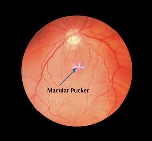 Macular Pucker St Leonards Detached Retina Eye Surgery North