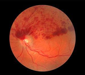 retinal-vascular-occlusion