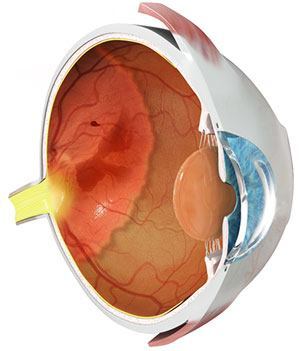 retinopathy_of_prematurity