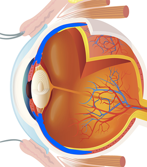 uveitis