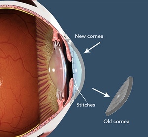 corneal-transplant