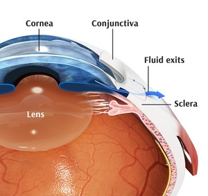 glaucoma-surgery