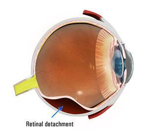 retinal_detachment