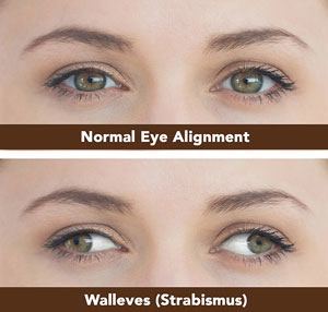 strabismus